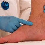 علایم اولیه واریس